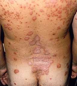 La Psoriasis es una enfermedad crónica de la piel que evoluciona por crisis y afecta el 2% de la población mundial. 