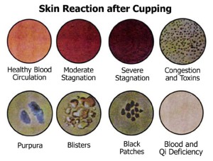 Skin-reaction cupping chinese